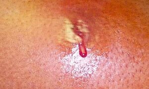 Pus Draining from Ruputured Abscess