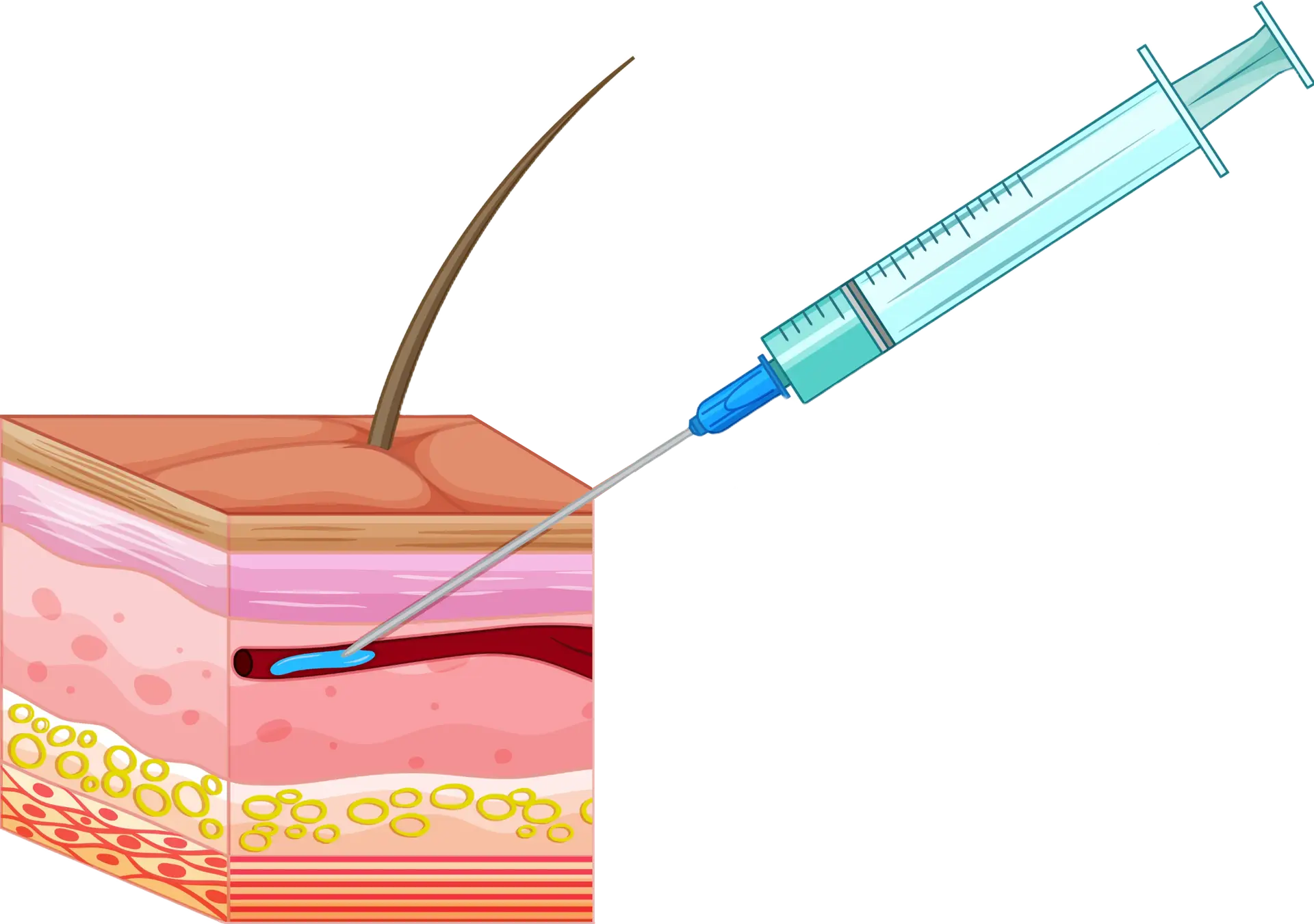 IV Needle in Vein Diagram