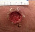 Severe Heroin Abcess