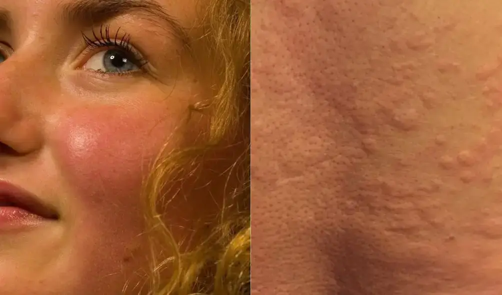 Suboxone Rash Vs Hives