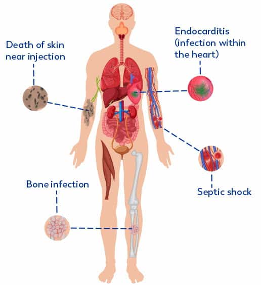 Side Effects of Abscess Include Sepis and Endocarditis
