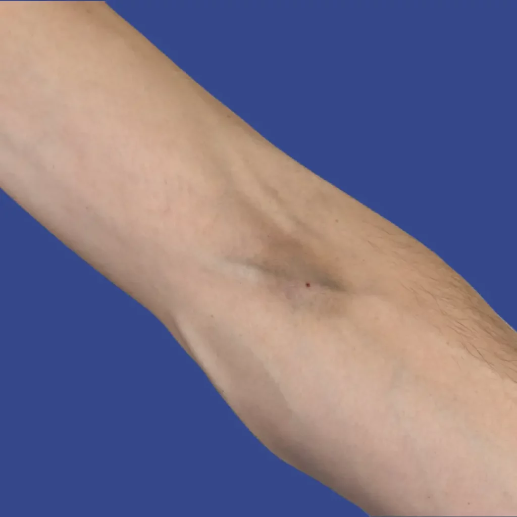 Track Mark Bruise