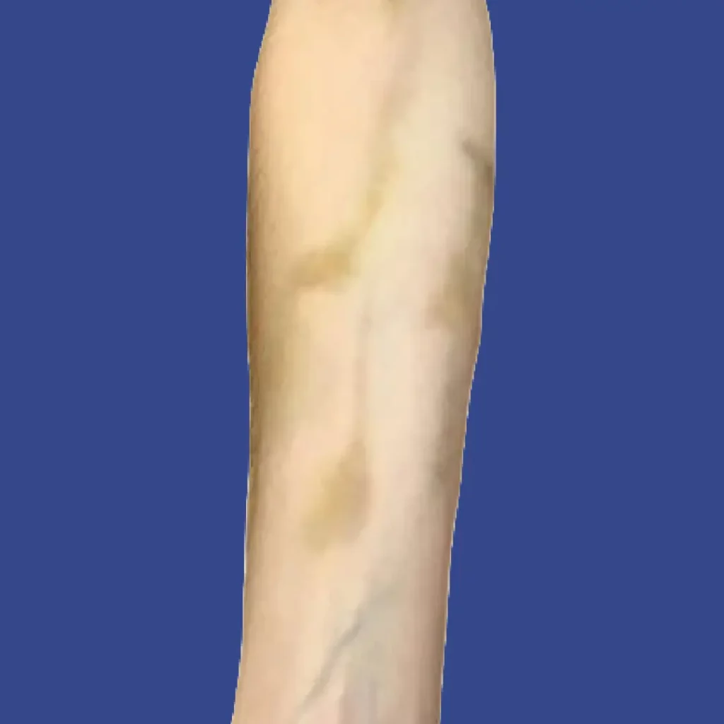 Hyperpigmentation Trackmark
