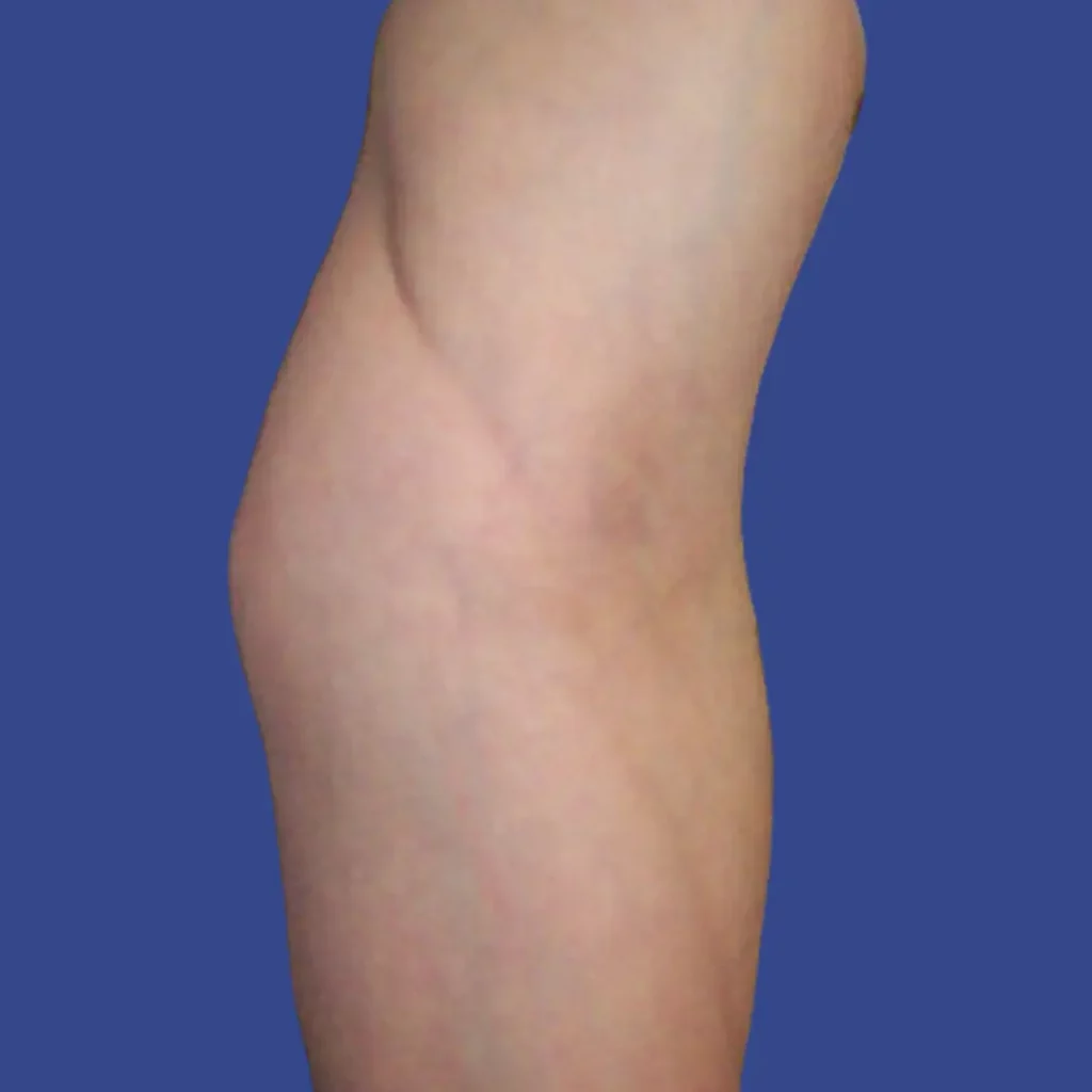 Indented Vein Track Mark