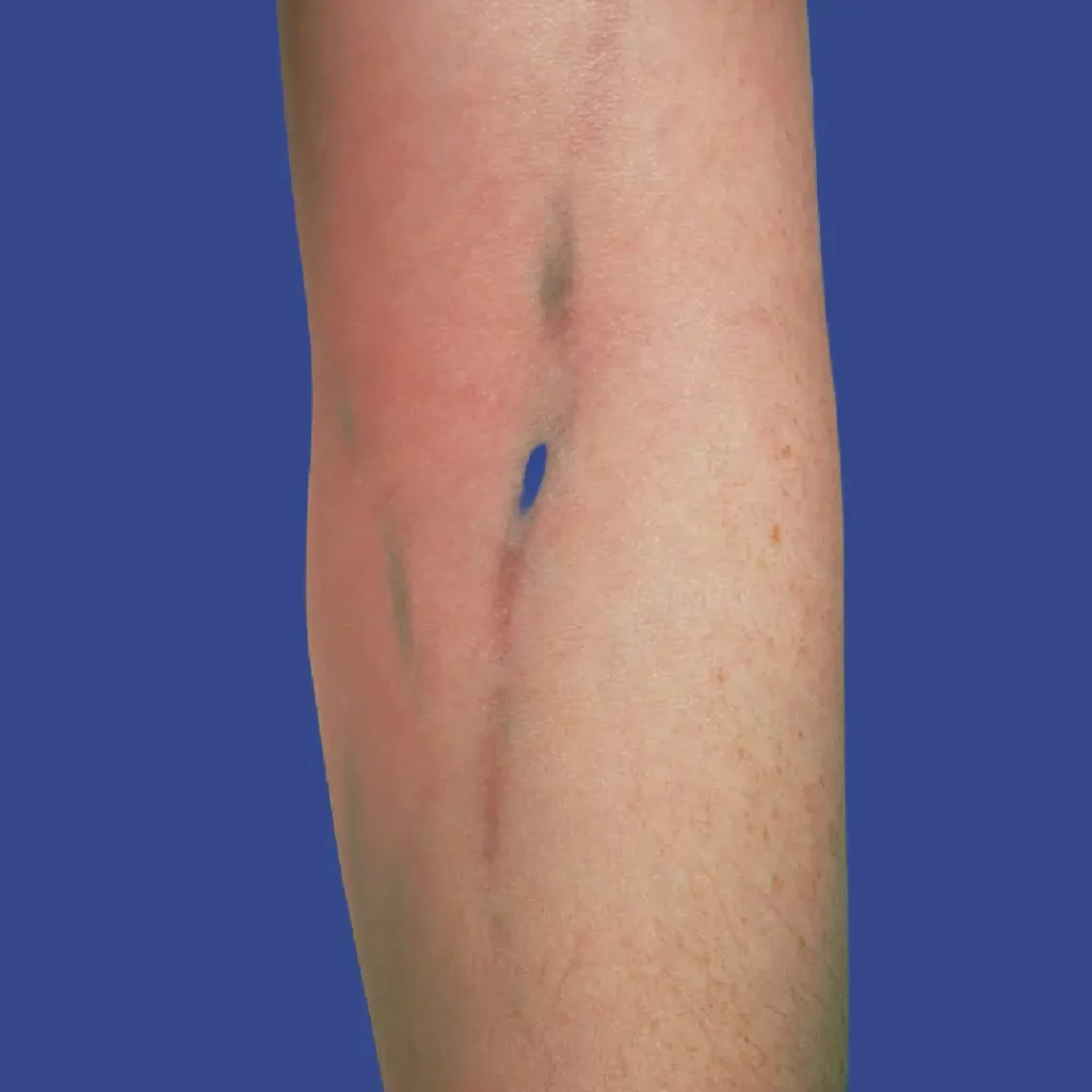 Track Mark Vein