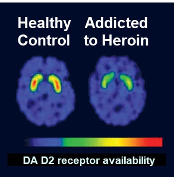 healthy brain showing much more DA D2 availability
