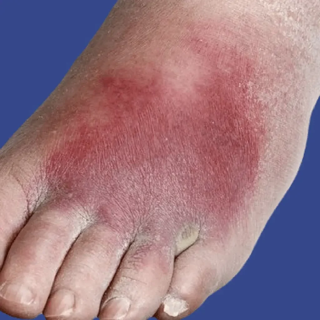 Cellulitis from IV Drug Use, Redness on foot