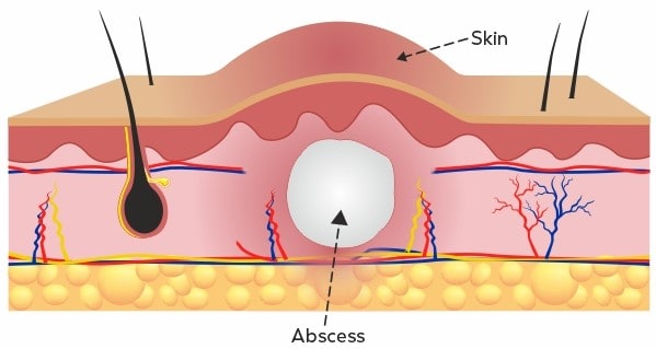 Abscess Under the Skin