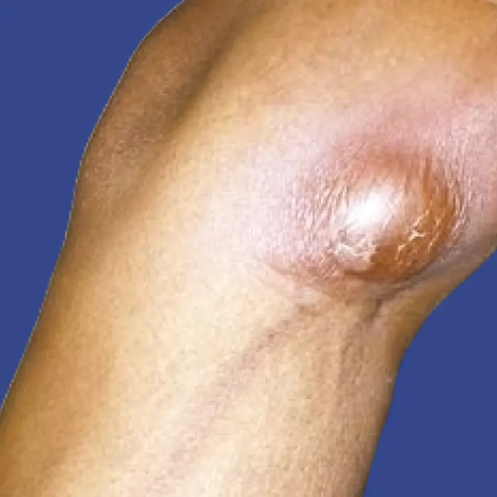 Heroin Abscess large biol on arm